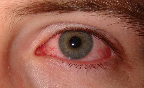 Dry-Eye-Syndrome