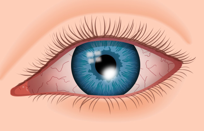 corneal-ulcer-660x425