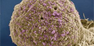 A cure for HIV? Feasible but not yet realized