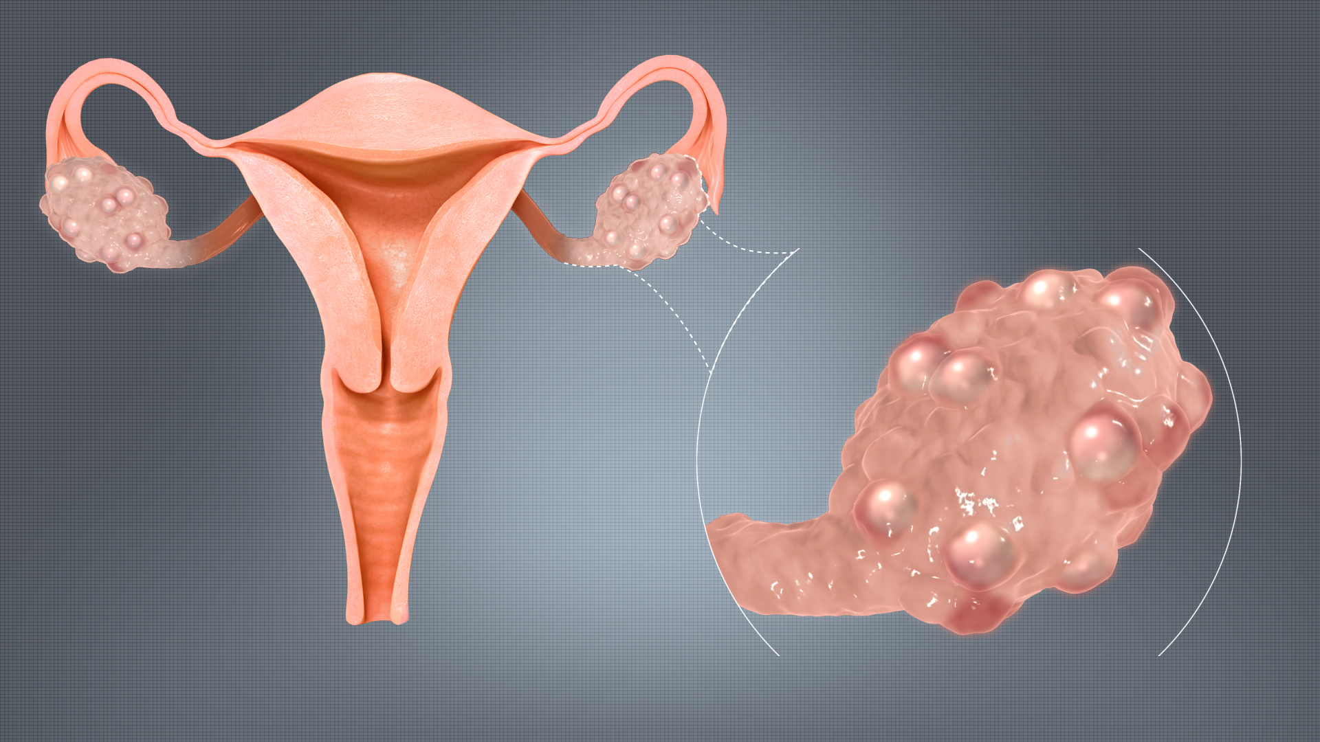 women-s-pcod-and-pcos-problems-explained-in-nepal-s-context