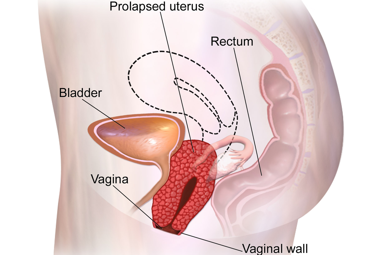 A labelled diagram of uterine prolapse