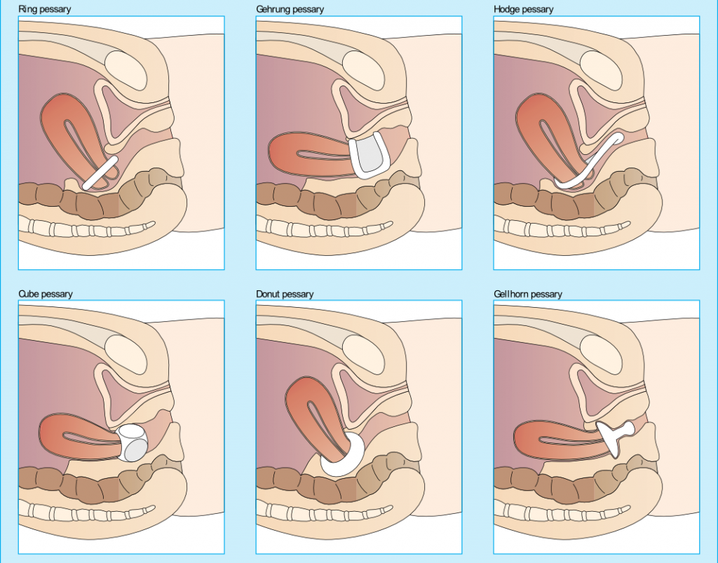 vaginal Pessary used to prevent uterine prolapse