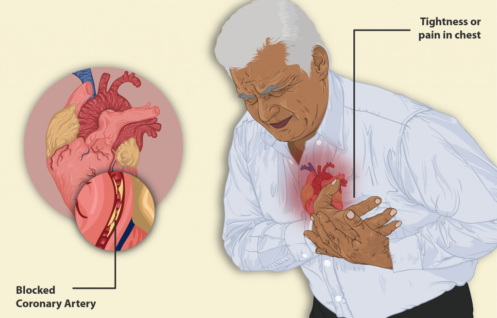 A representational image of a man having a heart attack. Photo: Wikimedia Commons