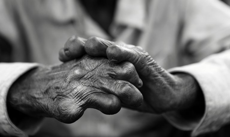Leprosy in Nepal: A man with hand deformity caused by leprosy.