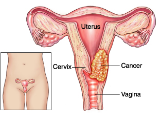 Cáncer de cuello uterino en Nepal