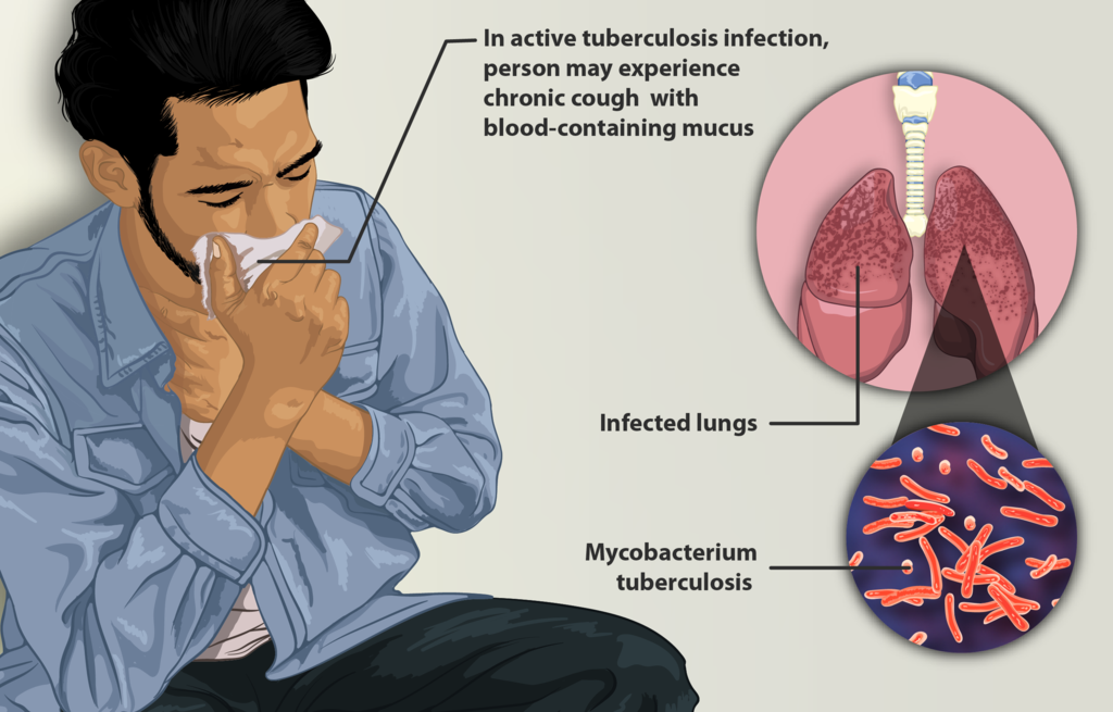 Tuberculosis in Nepal