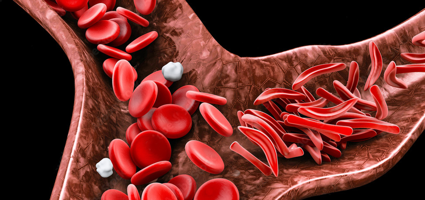 sickle cell disease