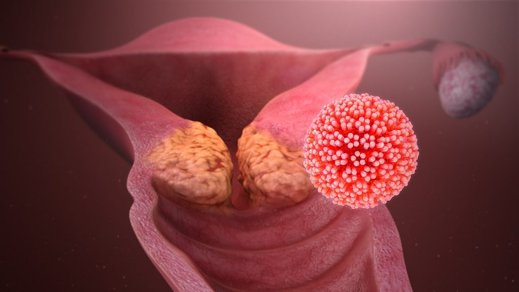 HPV causing cervical cancer