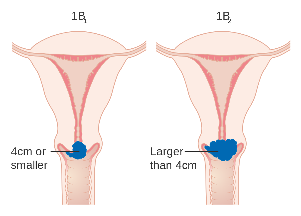 Diagramma che mostra la prima fase del cancro cervicale.