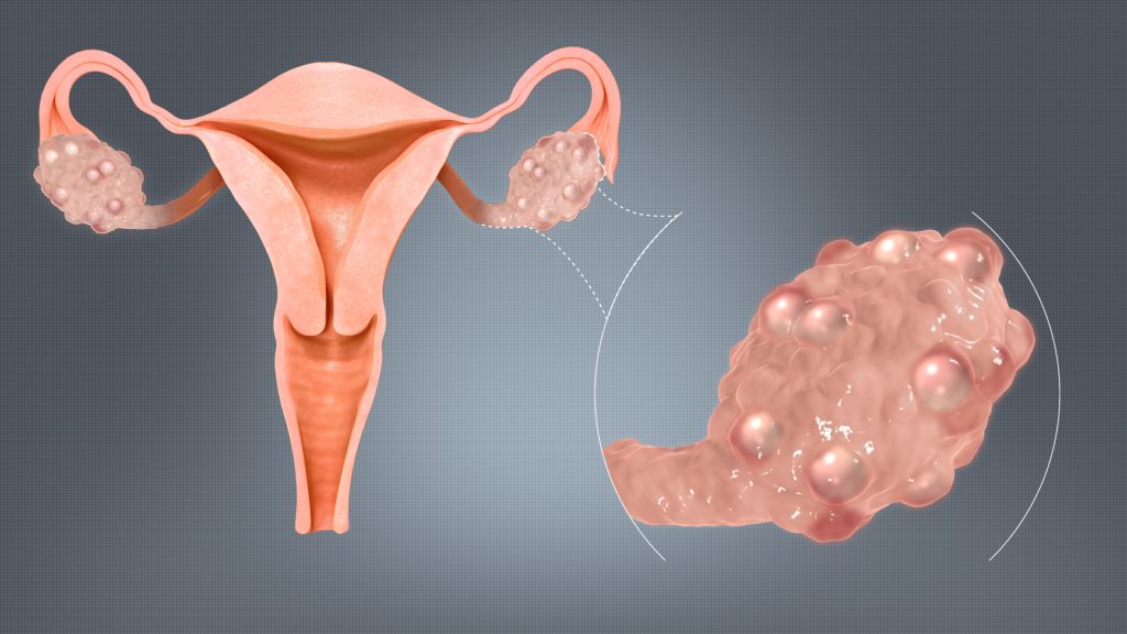 Image to represent polycystic ovary syndrome (PCOS). Wikimedia Commons