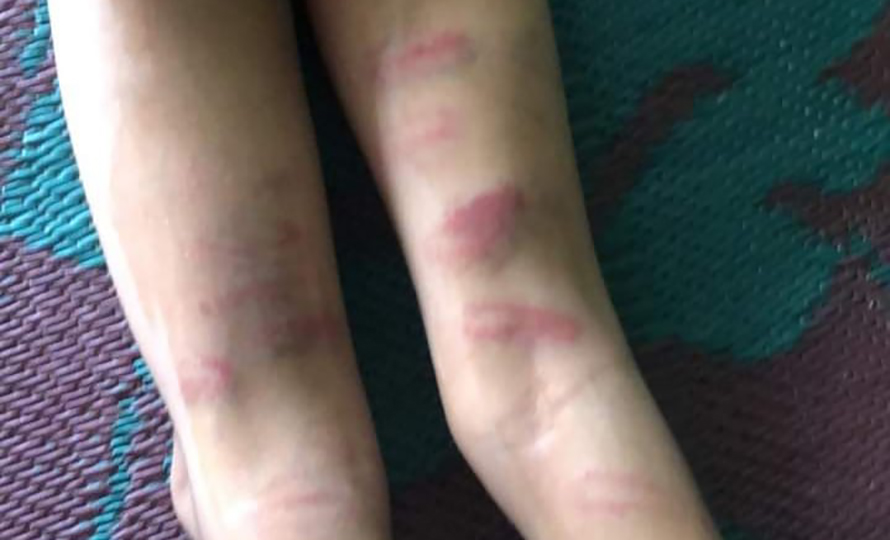 Bruises on a child's legs following a teacher's torture, in Damak, Jhapa, in March 2023. 