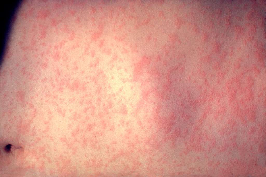 Govt report states measles has spread in 16 districts