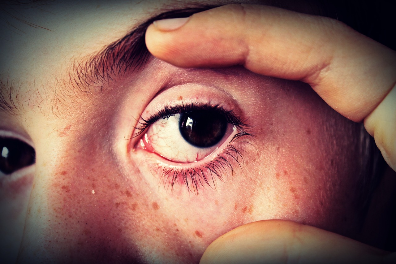 Conjunctivitis is spreading across the country. Here’s what you need to know about the virus