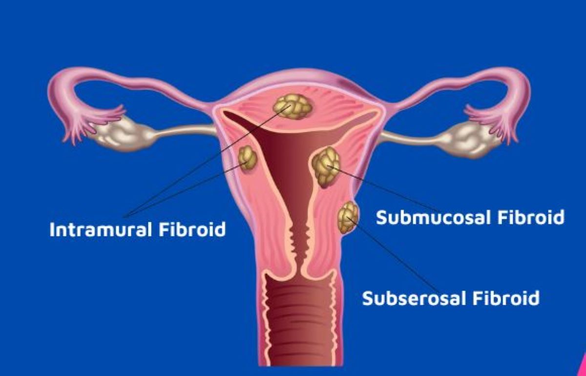 Uterine Fibroid in the context of Nepal women