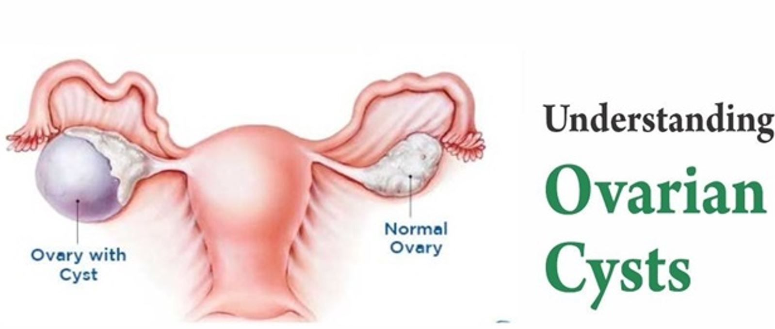 Ovarian Cyst Pain Treatment Ovarian Cysts Symptoms LXAYR Ovarian Cyst Pain Treatment Ovarian Cysts Symptoms LXAYR